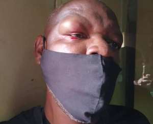 Zambian journalist Francis Mwiinga Maingaila is seen after he and another journalist were attacked by supporters of the ruling Patriotic Front. Photo: Francis Mwiinga Maingaila