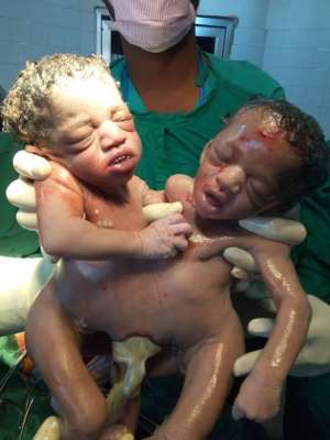 Ejura: Woman Gives Birth To Siamese Twins