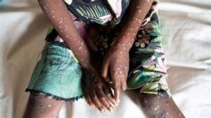 Ghana records six new Mpox cases, total rises to 85