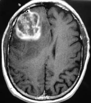 The War Within: New Hope in the Battle Against Glioblastoma