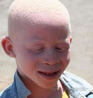 Stop Stigmatizing Persons With Albinism- Modern Women Of Wisdom International
