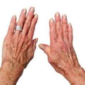 What Are Rheumatic Diseases?