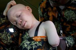 Albinos in Africa are deliberately killed for ritual purposes