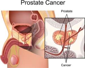 Prostate Prostrates To Zinc