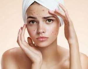 How To Treat Acne In 3 Days