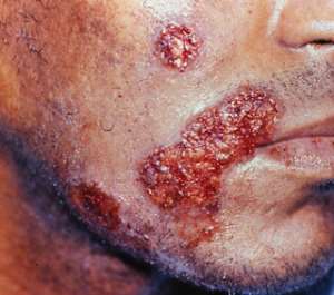 Chronic Ulcerated HSV Lesions on Face