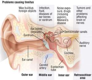 Tinnitus is divided into two kinds according to vibration frequency, low and high tones