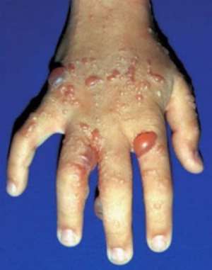 Blistering skin lesions on hand of a patient with poison ivy (Contact dermatitis)