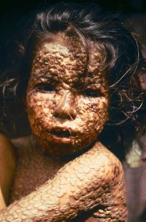 The disastrous effect of smallpox bio-weapon virus