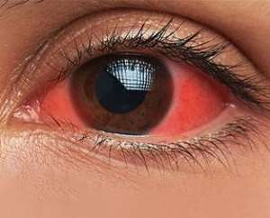 Why Eye Flu Cases Surge During Monsoon — And How to Protect Yourself