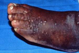 More evidence of the deliberate spread of Kaposi39;s sarcoma in Africa