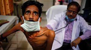 Why Mass Tuberculosis-Infection Of People With Aids?