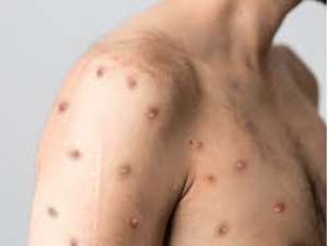 SAA calls for urgent action against Monkeypox crisis