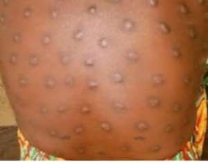 Asukawkawcommunities hit with blackfly bites