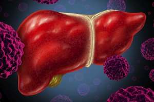 Hepatitis B causes 75% of liver cancer cases in Ghana – Experts
