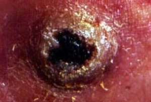 Skin manifestations of Kaposi39;s sarcoma