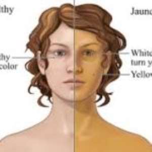 Home Remedies For Jaundice