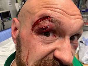 Fury Shows Off bloodied Wounds From Fight With Wallin