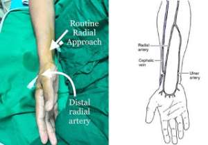 Better Approach For Angiography And Angioplasty