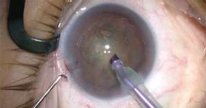 5 Causes And Aymptoms Of Cataract