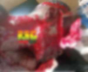 Awutu Senya West MP pays medical bills of NDC branch youth organiser butchered for pocketing Ghc600