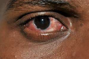 GHS warns of rapid spread of Apollo in all 16 regions