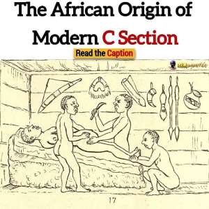 The African Origin of Modern C-Section