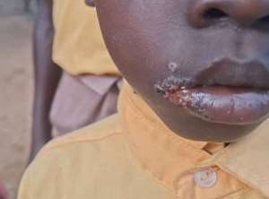 Mysterious Illness Leaves Children Struggling to Walk, Hear in Mafi Kope, Nkwanta South