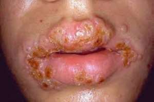 Gonorrhea-mouth infection