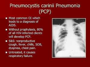 Planned Pneumocystis Carinii-Pneumonia Mass Disease