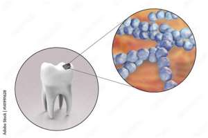 Tooth Decay: The Bacterium Behind Most Cavities