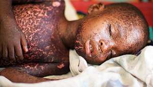 A young boy victim of measles
