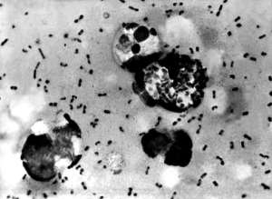 US Centers For Disease Control CDC file image shows bubonic plague bacteria taken from a patient.  By  CDCAFPFile