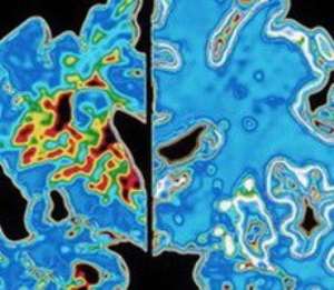 Scientists say they have identified a possible genetic link between diabetes and Alzheimer's disease.