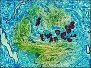 Protein behind Alzheimers fits
