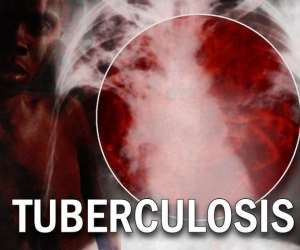 KICK TB Campaign to start earnestly in Ghana