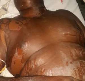 NPP Chairman Killed In Acid Attack