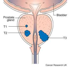 Doing Prostate Massage: My Research on why Some Men opt for Anal Sex orientation?