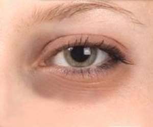 Dealing With Dark Circles Under Your Eyes
