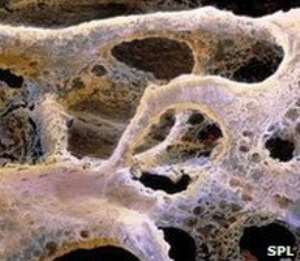 For many people, breaking a bone is their first clue that they have the condition