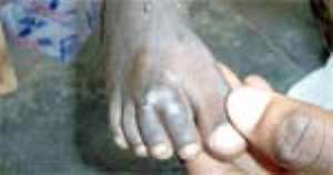 Guinea Worm Cases Drop By 83