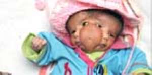 Two-Face Baby Born