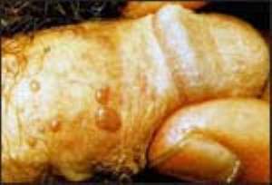 Genital Rash Can Transmit HIV