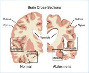 Navigating the Maze of Alzheimer's Disease and How We Can Make a Difference