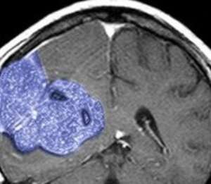 The trial is being conducted on patients with brain cancer