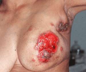 Breast Cancer