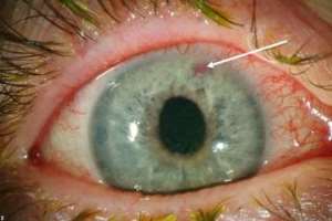 General information on glaucoma- The silent thief of sight