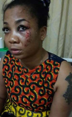 Vicky Zugah after her accident
