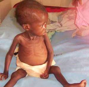 A malnourished baby