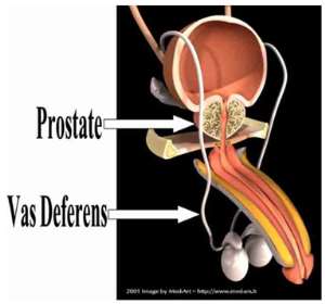 Prostate Cancer: Lifestyle, Not genetics  Why You will be affected?